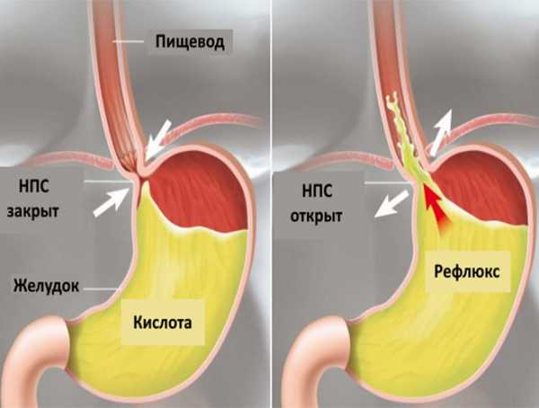 рефлюксный эзофагит нижней трети пищевода симптомы лечение