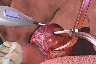 когда вырезают гланды симптомы и лечение